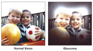 Glaucoma Example